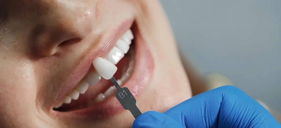 Dentista comparando a cor do dente com uma escala de cor para faceta