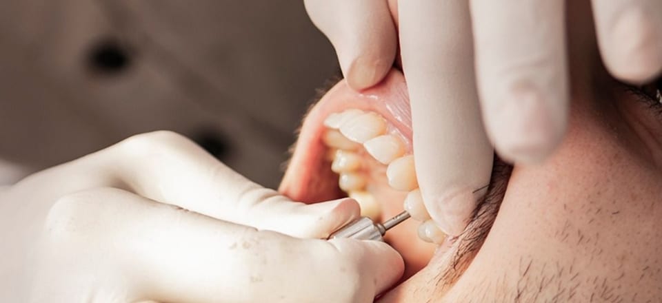 Procedimento odontológico sendo realizado na arcada de um paciente